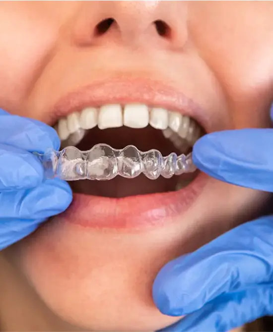 Invisalign Treatment